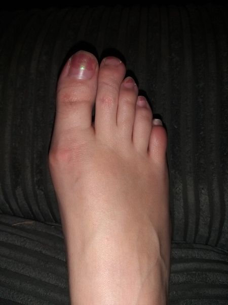 Bunions! Picture of my foot attached!