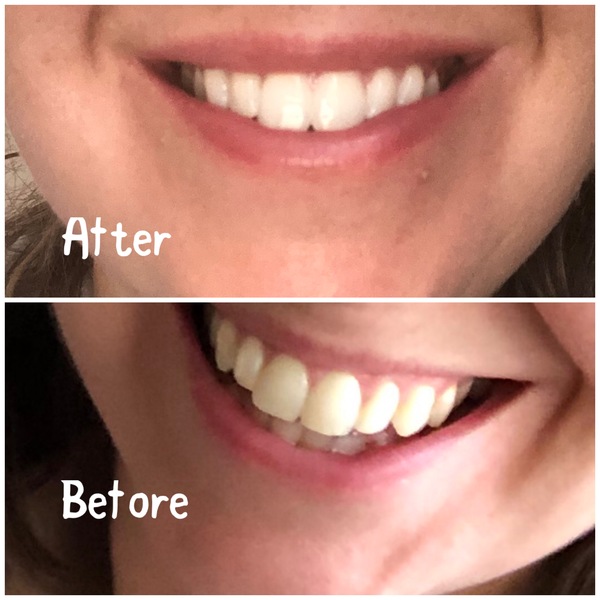 Lip fillers, your experiences?