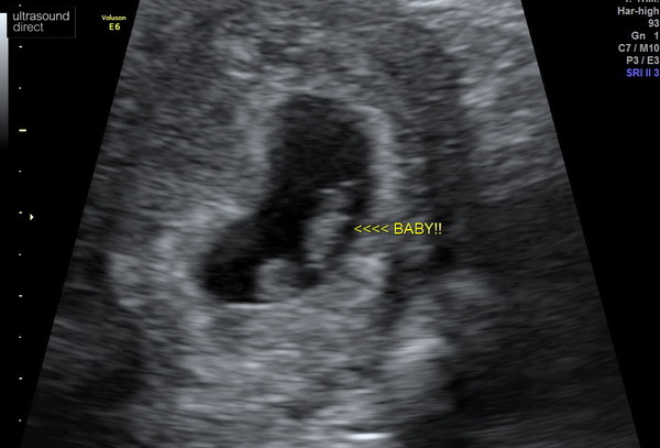 Babybond early scan