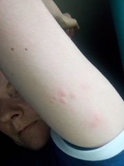 Is this an allergic reaction adult
