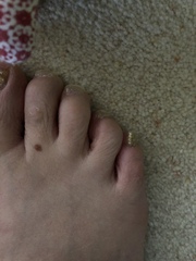 Nothing they can do about a broken toe is there. **pic** not very pretty.