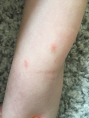 If not chicken pox what could this be?