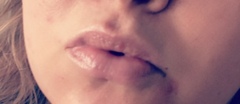 Lip fillers, your experiences?
