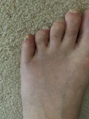 Nothing they can do about a broken toe is there. **pic** not very pretty.