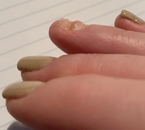 Lost fingernail - how to protect sensitive nail bed? (with pics)