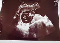 Due March 2020 - FIRST BABY in late 20's