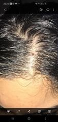 Mole on scalp