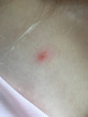 If not chicken pox what could this be?