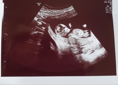 Due March 2020 - FIRST BABY in late 20's