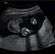 Potty shot - boy or girl?