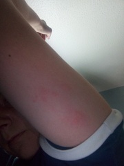 Is this an allergic reaction adult