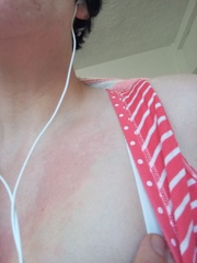 Is this an allergic reaction adult