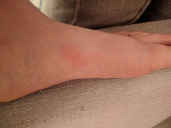 Do these look like bed bug bites?