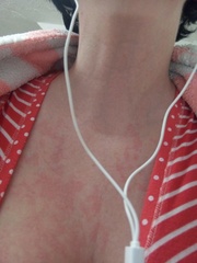 Is this an allergic reaction adult