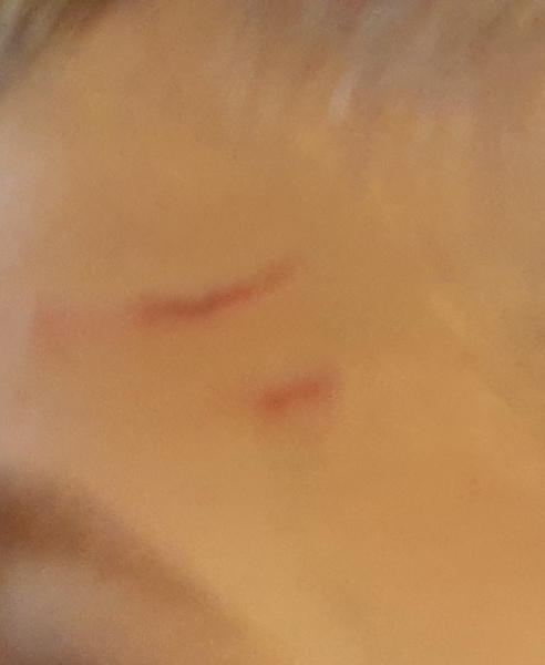 Son scratched and pinched on face at school