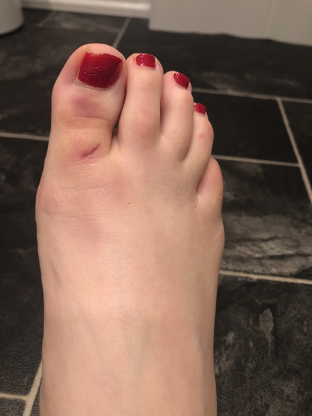 AIBU to think it’s normal for cuts to bruise?!