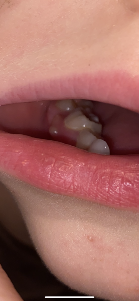 What’s this on my sons gum? Pics