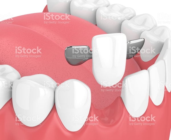 Crap teeth are making me feel so low