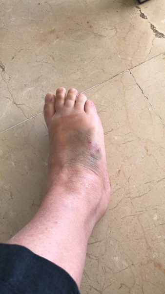 To ask for your ridiculous injuries stories