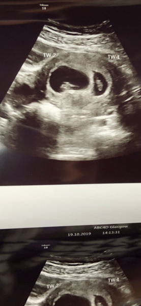 Expecting twins in 2020?