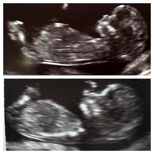 Boy or girl