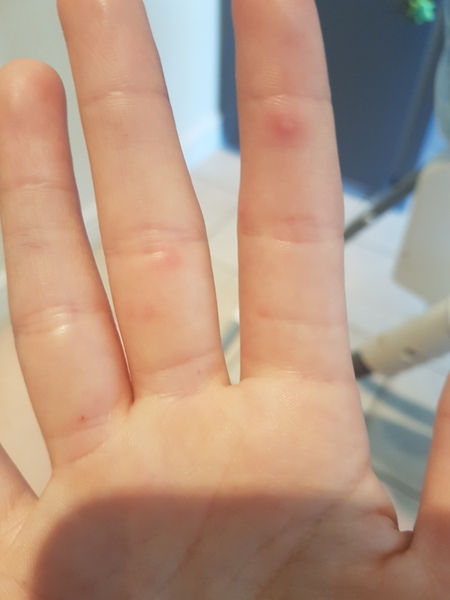 Painful blisters all over my hands and fingers, ideas!?