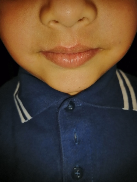 Swollen top lips