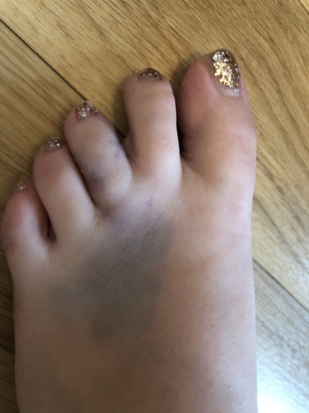 Can I ask for advice re. Possible broken toe?