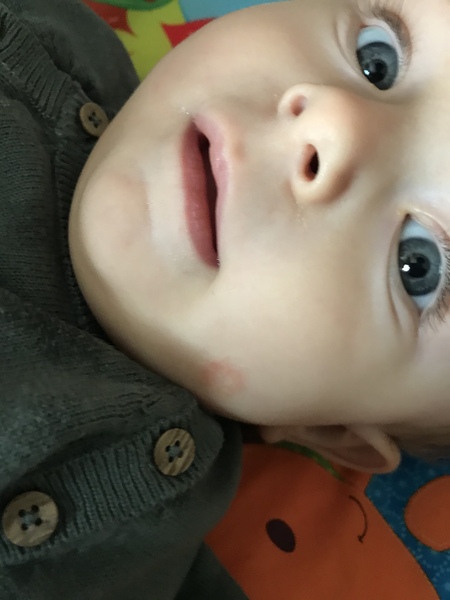 What’s this on 7 month DS’s face?