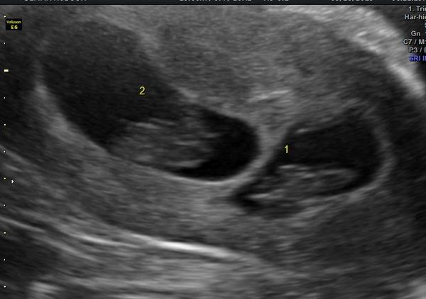 Expecting twins in 2020?