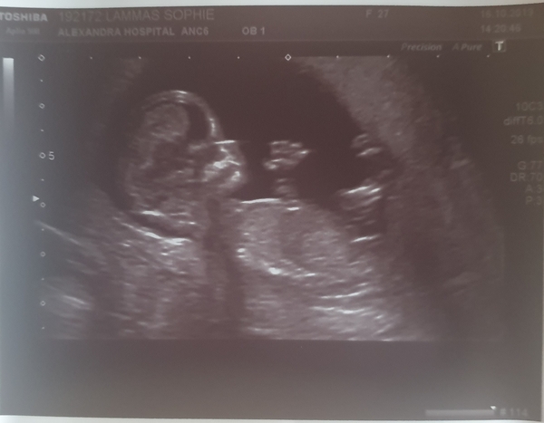 12 weeks - nub ?!?