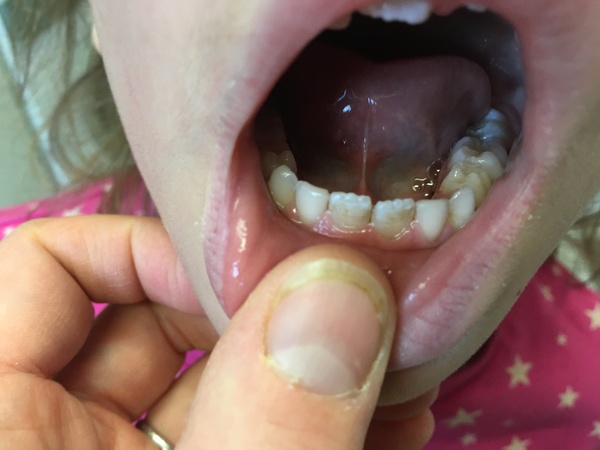 Any dentists around? Child wobbly permanent tooth
