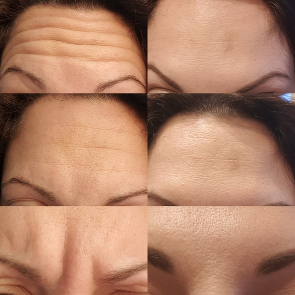 What can I do about my laughter lines?