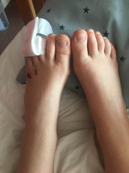 DS 11 can’t weight near after fall - A&E or wait and see?