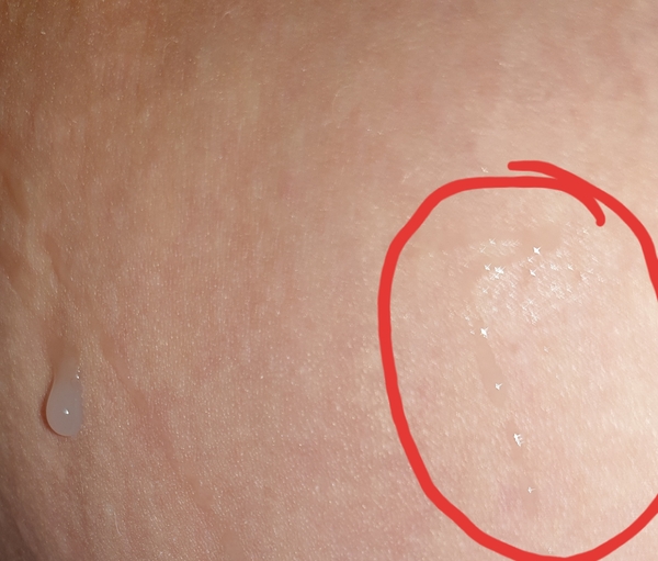 TTC and discharge. Warning Slightly graphic image nothing major