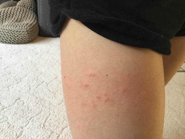 What are these bites?