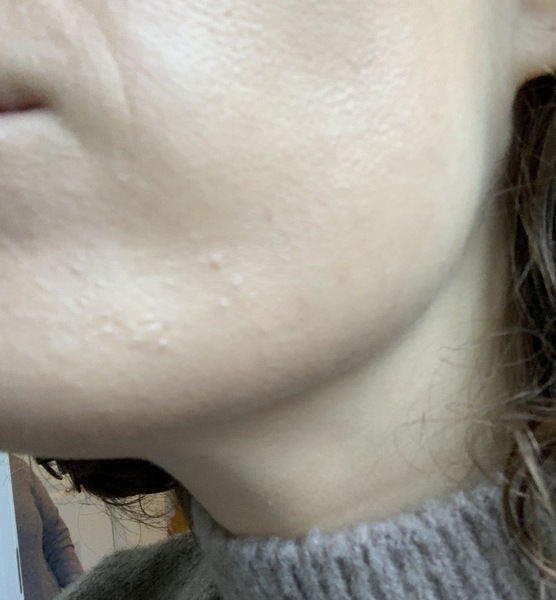 Skincare - is this a reaction or congestion?