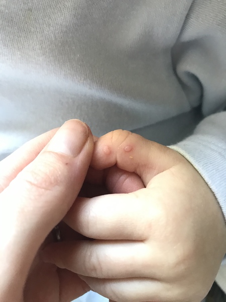 What are these little blisters?