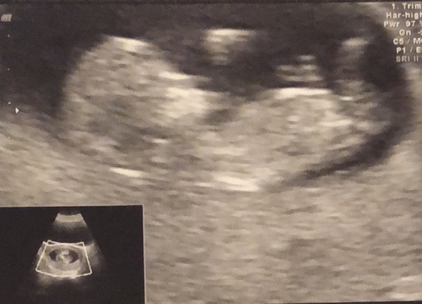 12 weeks - nub ?!?