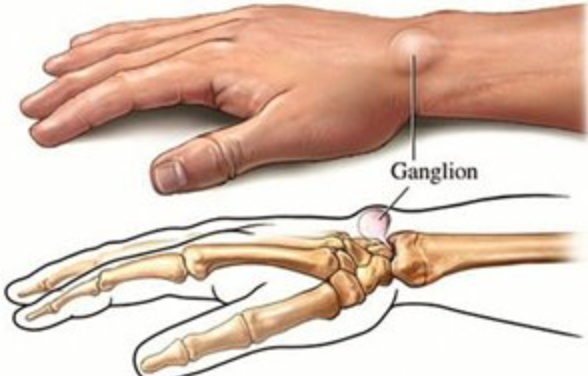 Anyone had a hard ganglion?