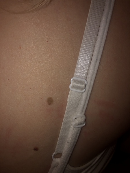 Would you be worried about this mole?
