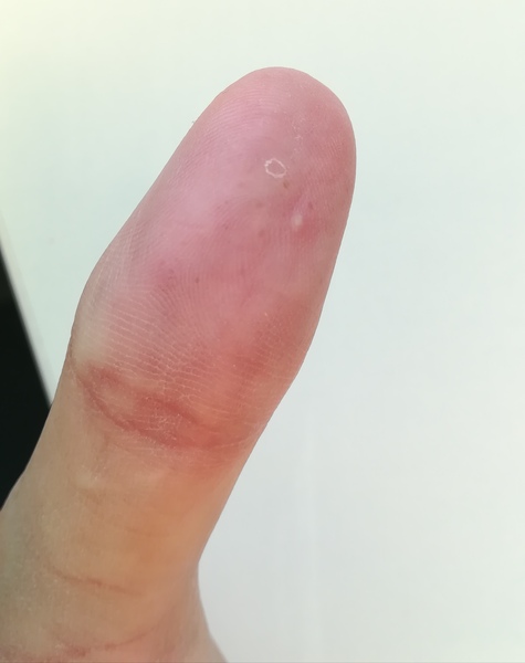 Who wants to diagnose my thumb?