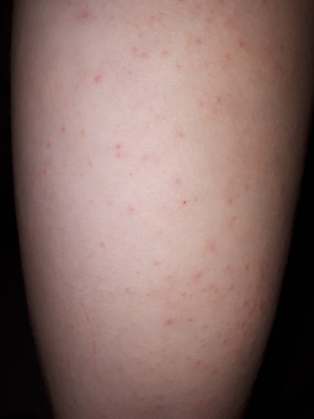 Is this just eczema?