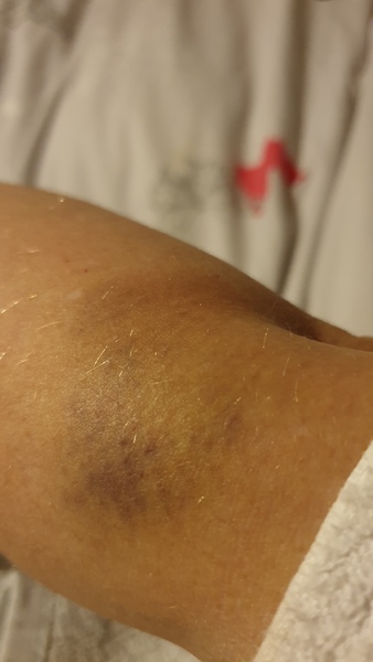 To ask for your ridiculous injuries stories