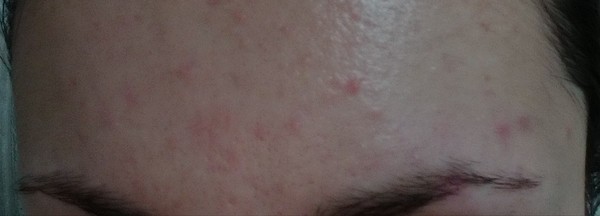 Is this acne?