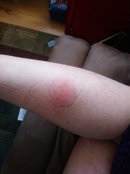 Wasp sting. Does this need medical attention?