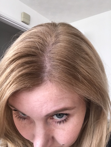 Freaking out over this hairloss!!!