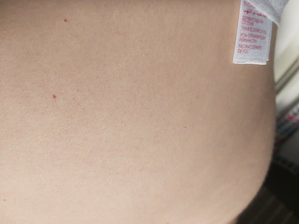 Is this rash worth a GP appointment? Pic attached