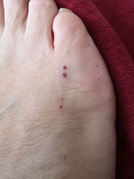 What has bitten me?