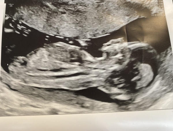 Pregnancy after Miscarriage
